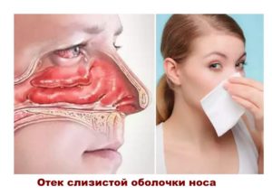 После септопластики отек носа