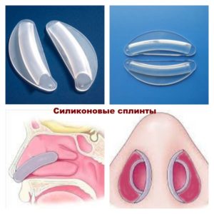 Установка сплинтов после септопластики