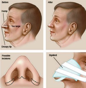 4 рисунка по ринопластике