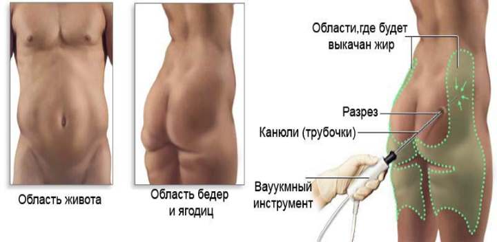 Метод РЧЛ
