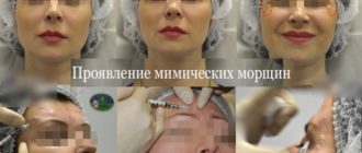 Места для введения ботокс